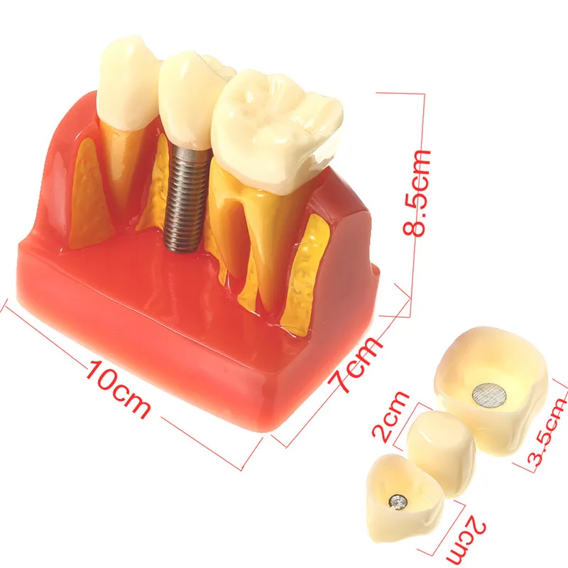 4 раза модель Зубов Стоматологический имплантат анализ Корона мост демонстрация Стоматологическая модель Зубов Стоматологический Инструмент модель исследования