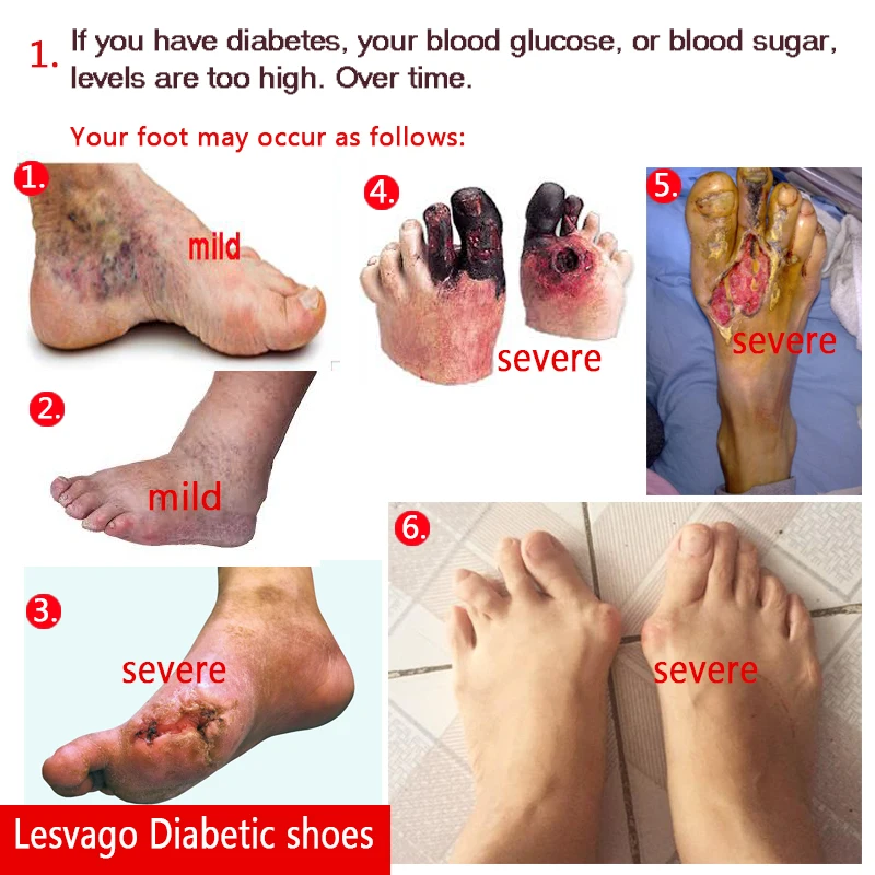 sapatos para pes diabeticos