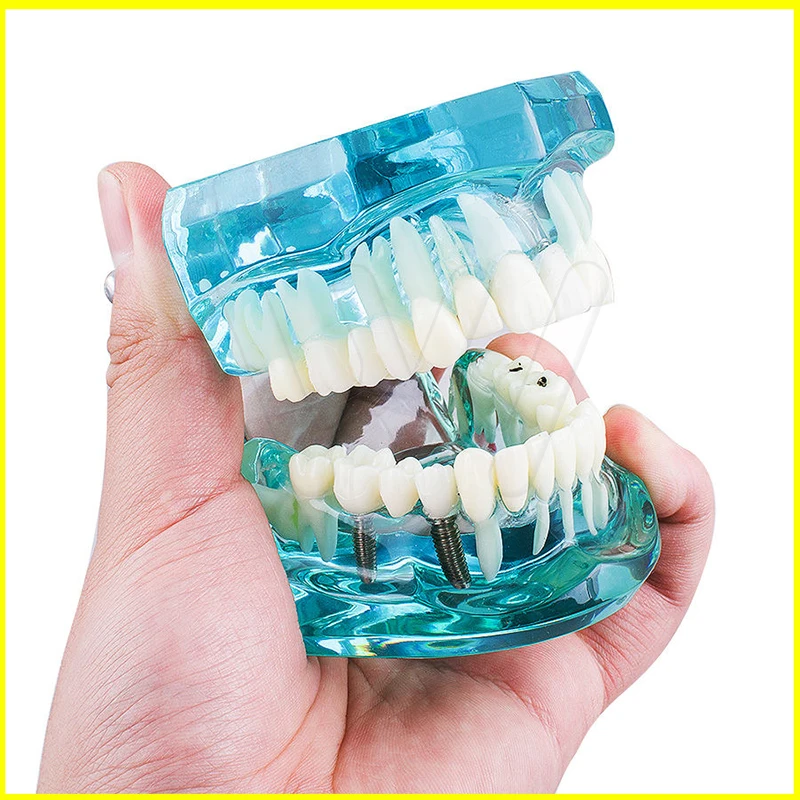 Dental Study Tooth Model Adult Pathological teaching Teeth model new denshine (1)