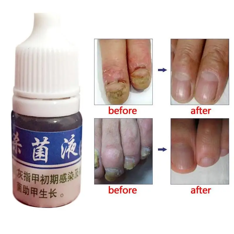 

10ml Health Skin Care Nail Repair Treatment Liquid Cleanser Onychomycosis Remover Serum Beauty Disinfect Water ZBY8II9