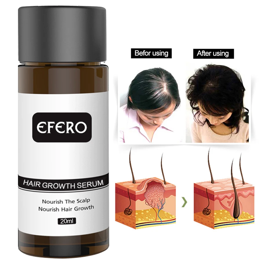 EFERO 2 шт быстро мощная эссенция для роста волос, продукты для выпадения волос, Эфирное лечение для мужчин, для женщин и мужчин, продукты для ухода за волосами, 20 мл