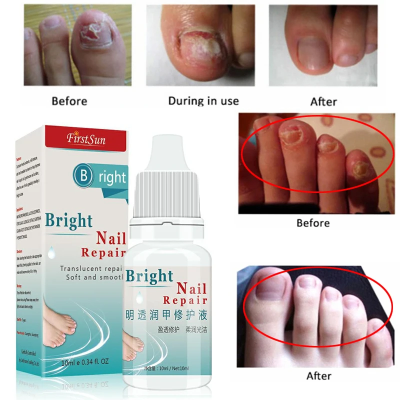 nail fungal infection cream)