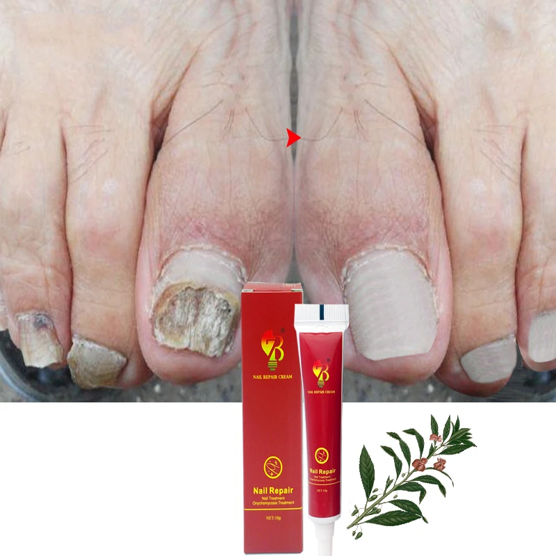 

High Quality Nail Protector skin care cream Finger And Foot Nail Treatment Herb Nails Repair Cream Nail Care