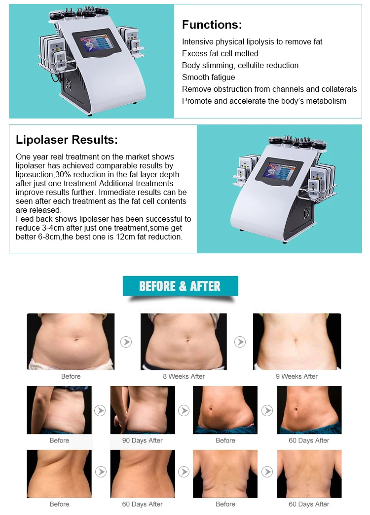 vácuo de radiofrequência laser 8 almofadas lipo