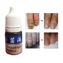 Грибок грибковый анти-Лечение ногтей жидкое средство для ремонта ногтей средство для снятия онихомикоза для восстановления ногтей жидкое моющее средство 10 мл
