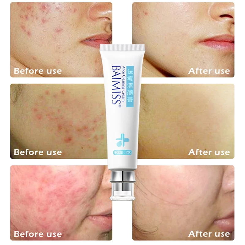 folliculitis moisturizer