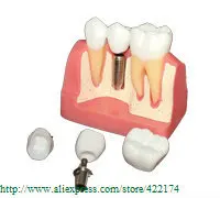Doprava zdarma Implantace model zubní zubní zuby zubař anatomická anatomie model odontologie