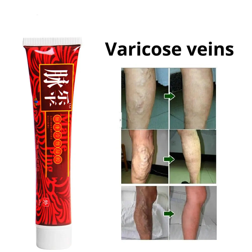 varicose unguent eficient