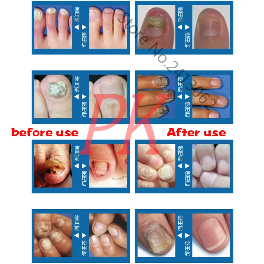 Tratamento de Fungos Unhas do Dedo do pé Unha do Dedo Infecção por Fungo Loção para o Tratamento de Remoção de Cuidados com as Unhas Herbal Essência Anti Unha Nas 6 Weddings & Events