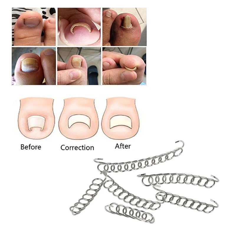 1 компл. вросших ногтей ног леска для коррекции устройство фиксации для педикюра восстановить Бурсит большого пальца стопы Корректор