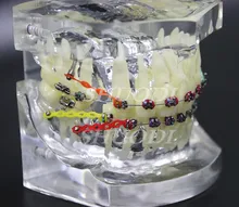 Transparent Dental Orthodontic Mallocclusion Model with Brackets Archwire buccal tube Tooth Extraction for Patient Communication Transparent Dental Orthodontic Mallocclusion Model with Brackets Archwire buccal tube Tooth Extraction for Patient Communication