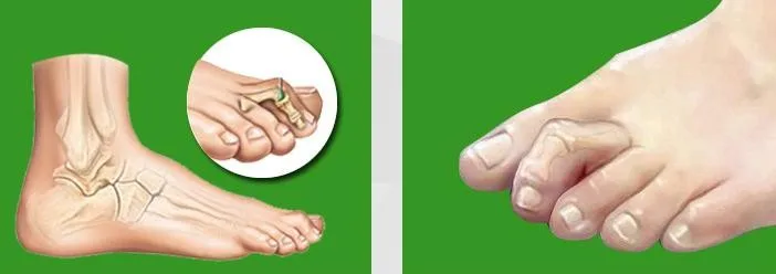 10 шт./партия разделитель пальцев ног вальгусная деформация ортопедическая плюсневая кривая перекрещивающаяся молоток выпрямитель для пальцев ног