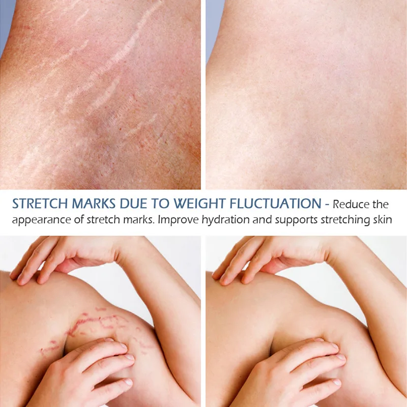 Удалить растяжки ремонт крем материнства кожи шрамы ожирение линии кожи Твердые гладкие уход за кожей тела шрамы TSLM1