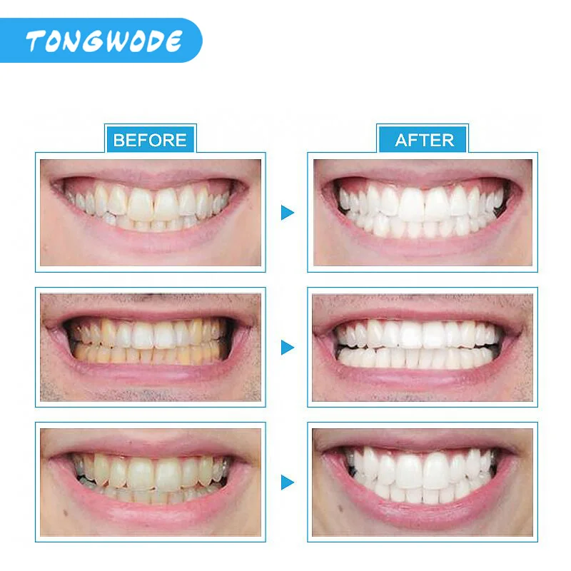 Tongwode мини-набор для отбеливания зубов, светодиодный Мощный удалитель пятен зубов, отбеливание зубов, домашняя система, не включает гель