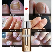 VIBRANTGLAMOUR Antibacterial Nail Treatments Herbal Essence liquid Nail Fungus Art Repair Foot Nail Care Improve Infection TSLM1