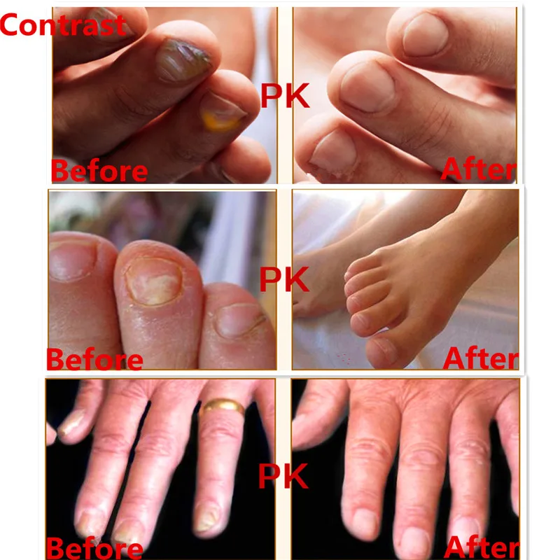 MeiYanQiong Fungal Nail Treatment Feet Care Essence Nails and Foot Whitening Toe Fungus Removal Nail Gel Treatments