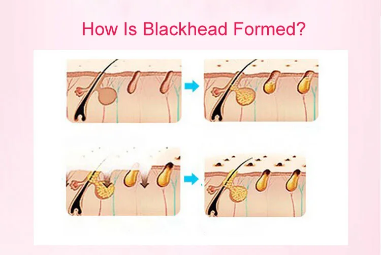Удаление Blackhead Comedo вакуумный очиститель для лица и носа, устройство удаления акне, микродермабразия кожи оборудование для пилинга
