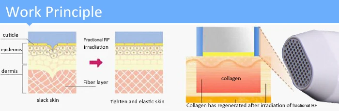 Радиочастотный точечный RF матричный фототермический фракционный RF аппарат для подтяжки кожи