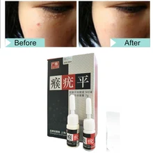 2pcs/set Ultra Strength Skin Tag Remover 12 hours Tu kill Medical Tu kill Remover Foot Corn Skin Tag Mole& Genital Wart Remover