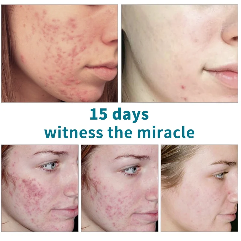 Acne Treatment Liquid Face Serum Shrink Pores Hydrating Anti-Acne Whitening Plant Cream Pimple Serum Moisturizing Skin Care