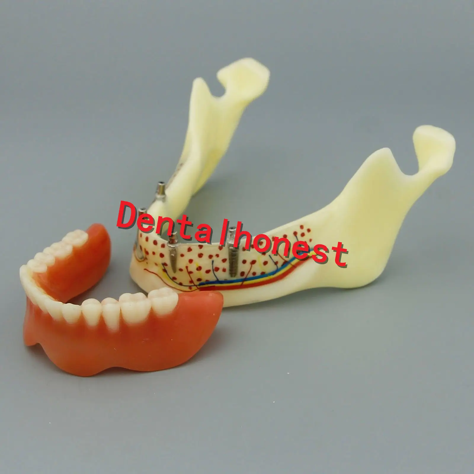 

Dental Mandible Implant Overdenture Teeth Model with vessels Demo Model 2014