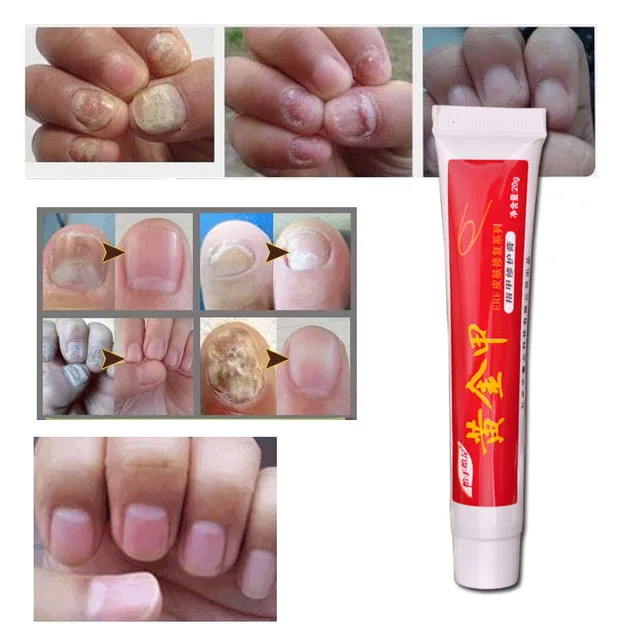 Antifungal oje - onikomikoz için etkili bir tedavi Antifungal oje - onikomikoz için etkili bir tedavi