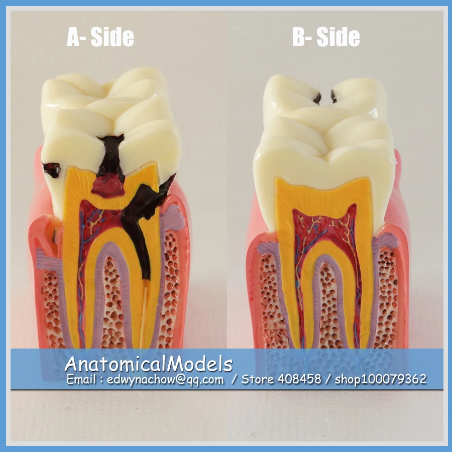 

13144 DH1302 Enlarged 6x Caries Comparation Tooth Model, Medical Science Educational Dental Teaching Models