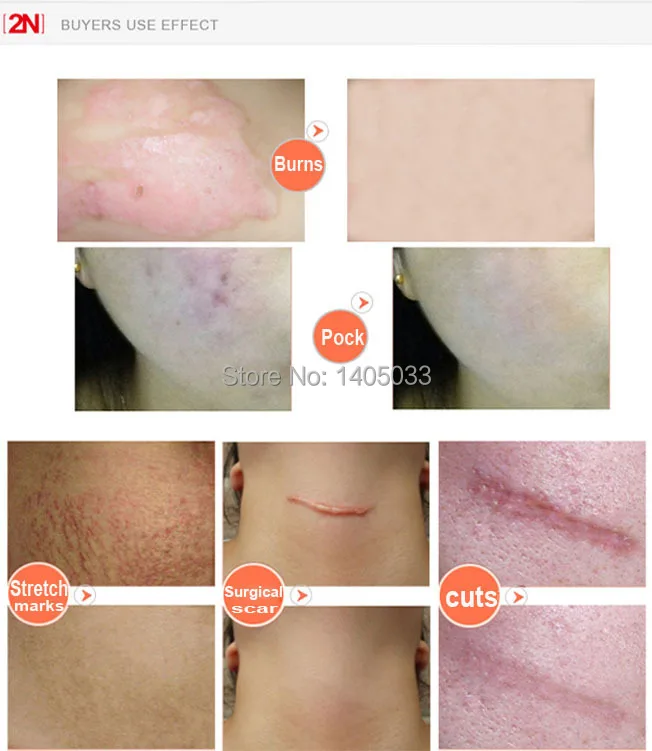 free shipping 1pc silicone sheet 1pc scar cream fast way to remove silicone sheets for keloids reviews