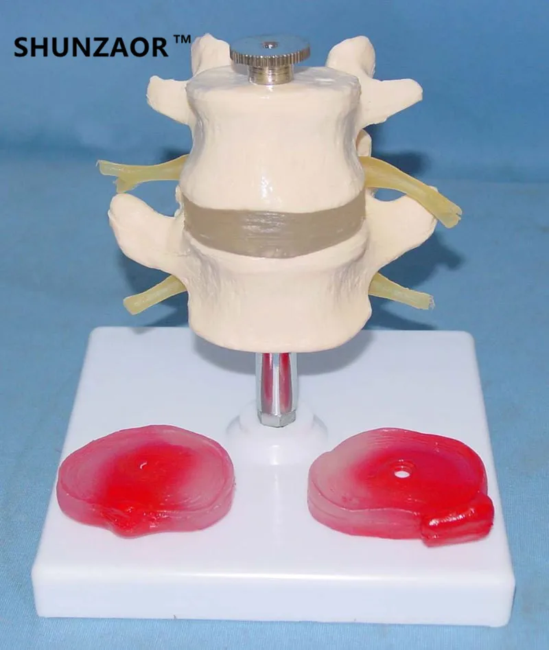SHUNZAOR 2 поясничные позвонки с 3 повреждениями межпозвонковый диск демонстрационная модель человеческого скелета модель