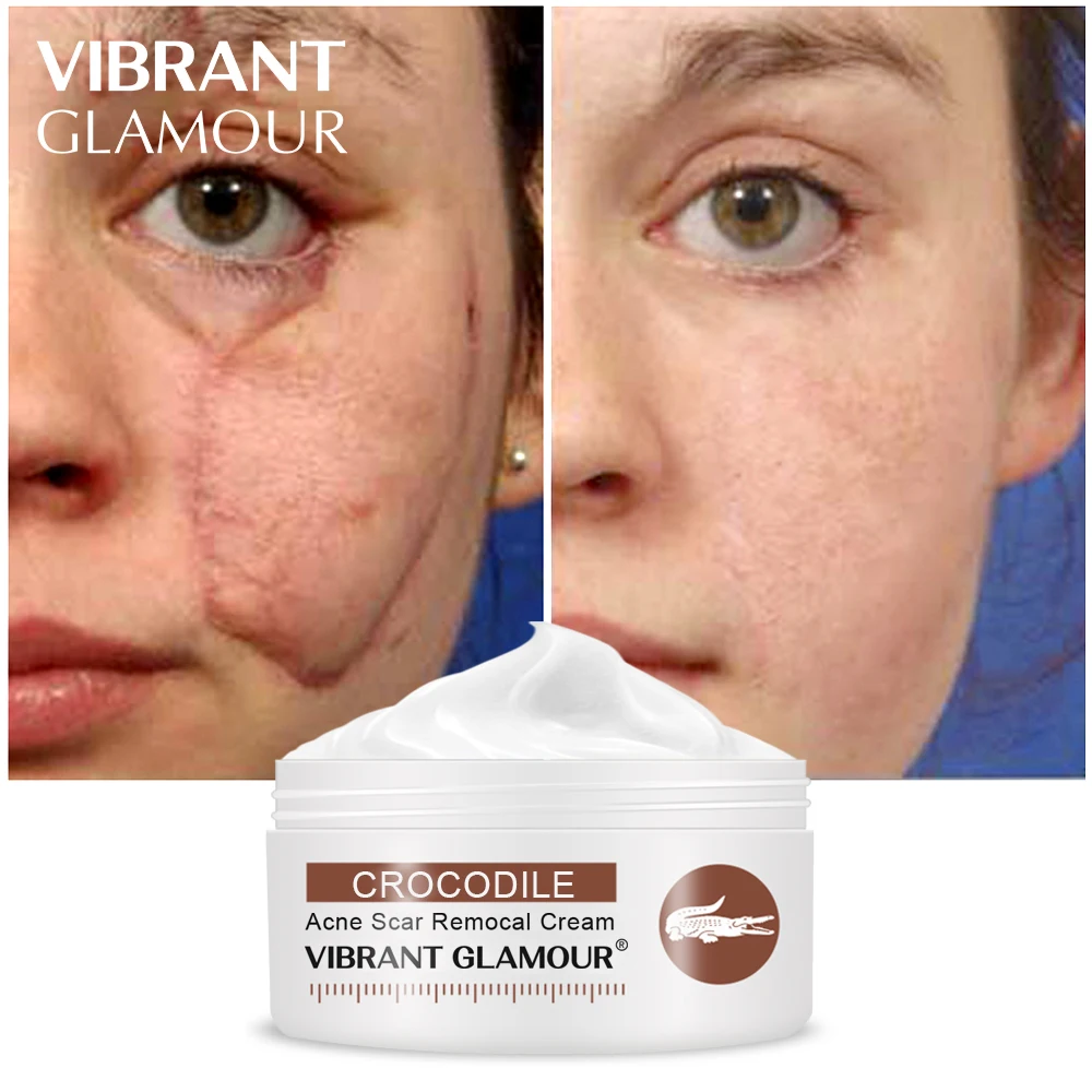 

VIBRANT GLAMOUR Crocodile Repair Scar Face Cream Removal Acne Spots Whitening Skin Anti Aging for Scald and Stretch Marks TSLM2