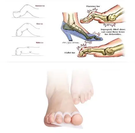 2 шт./партия силиконовый молоток палец с когтем разделитель для коррекции выпрямитель вальгусная деформация ортопедический гель для пальцев ног