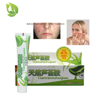 

2 packs Acne aloe gel remove pimples Acne ointment whelk cream suitable all skin Acne insect bites cream