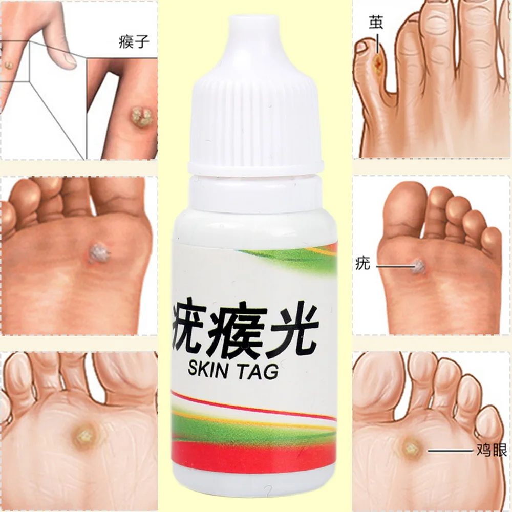 Body Warts Treatment Cream Skin Tag Remover Foot Corn Removal Plantar Genital Warts Ointment Foot Care Cream 10ML