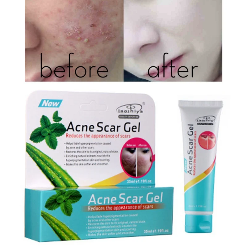 

Face Acne Treatment Skin Care Acne Remover Scar Cream Anti Acne Remove Moisturizing Deep Clear Cream