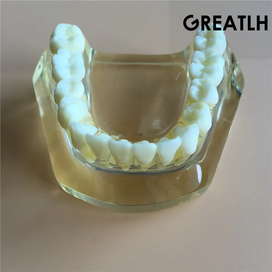 

Implant model with bridge and caries 1 implant dental tooth teeth model