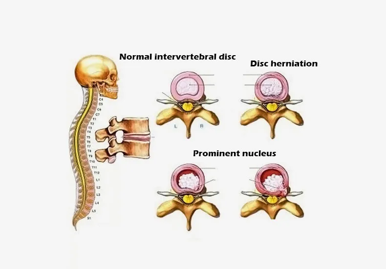 Lumbar-traction-device-B30-2-(9)