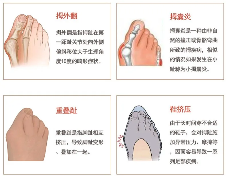 1 Pair Hallux Valgus Protector Feet Care Toes Separator Toe Gel Stretchers Bunions Straightener Foot Corrector Alignment Insoles (7)