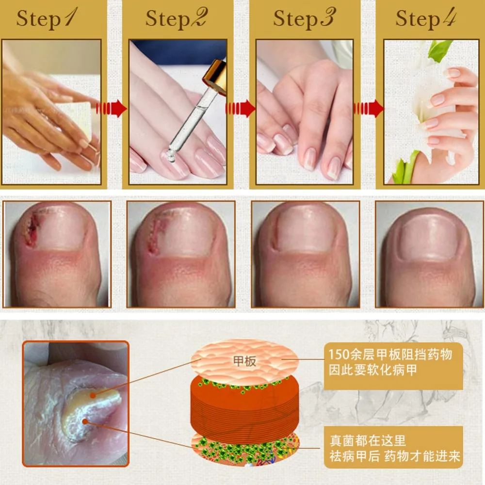 Анти-Лечение ногтей от грибка эссенция для ногтей и отбеливающий носок удаление грибка Уход за ногами и ногтями