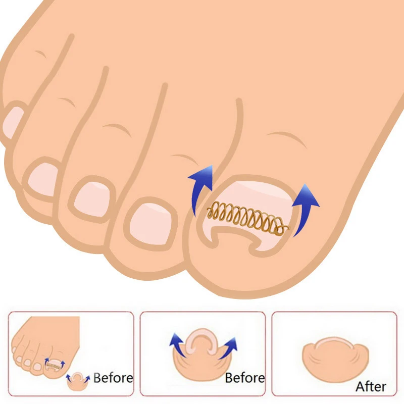 Monja 6 шт. вросший носок проволочный фиксатор для коррекции ногтей Педикюр Paronychia восстановление ногтей корректор Уход за ногами