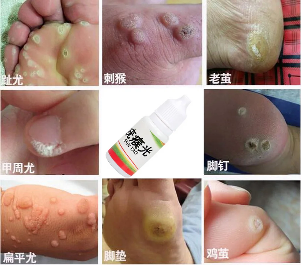 Body Warts Treatment Cream Skin Tag Remover Foot Corn Removal Plantar Genital Warts Ointment Foot Care Cream 10ML