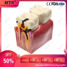 6 times Denture Teeth Model molar tooth contrast model Tooth Decay oral Dentist Pathologies teaching equipment dental instrument straight sissor bone rongeur forcep dentist equipment dentistry tooth denture teeth tool free shipping