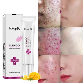 

Mango Repair Acne Cream Anti Acne Spots Acne Treatment Scar Blackhead Cream Whitening Moisturizing Shrink Pores Face Care