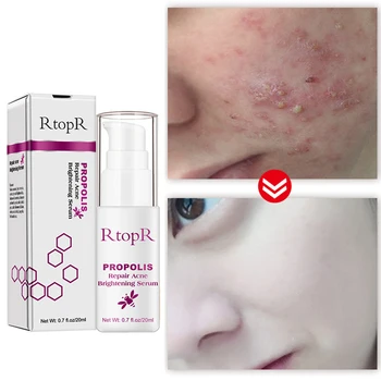 

RtopR Propolis Repair Remover Cream Acne Scar Acne Brightening Essence Acne Scar Essence Shrink Pores Eliminate Acne TSLM1