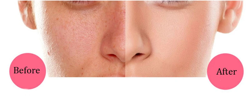 blackhead9888 (12)