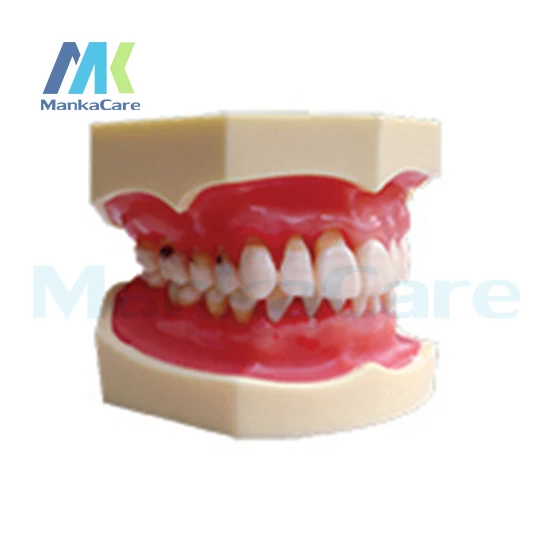 Manka Care - Peridontal Disease Model Oral Model Teeth Tooth Model