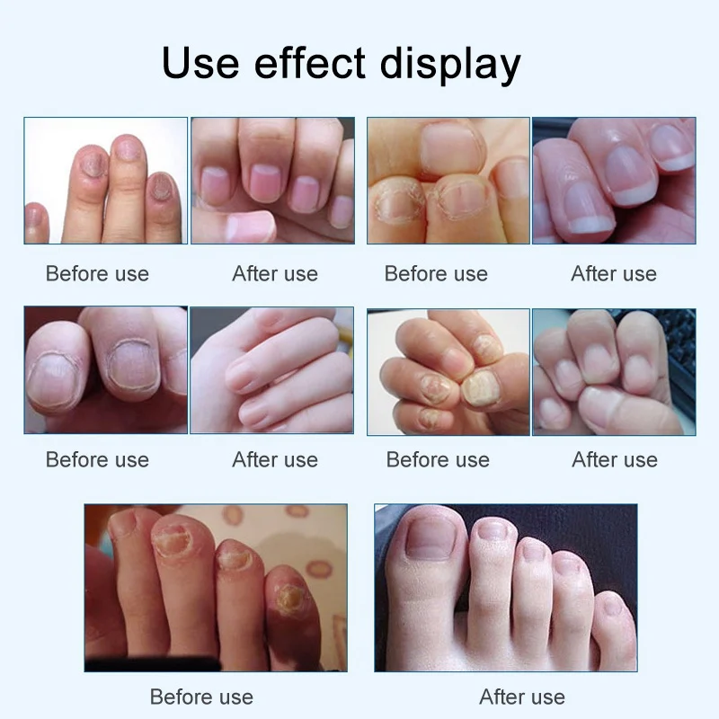 Полезная Ручка для лечения Ногтей Onychomycosis Paronychia противогрибковые инфекция ногтей китайский травяной носок Лечение грибка