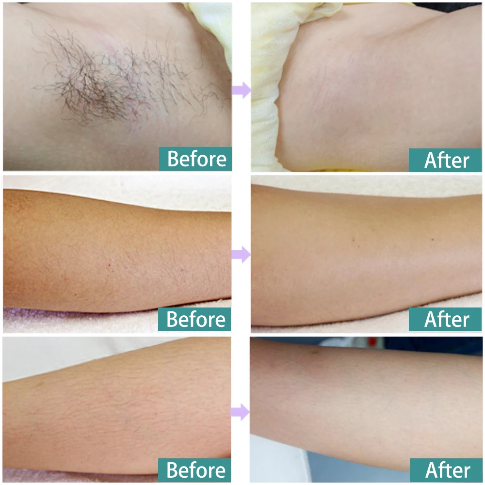 Ipl Hair Removal 350000 Pulses Depilador Hair Remover Machine Home Use Ipl Laser Lamp Skin Acne Repair Machine For Face and Body (17)