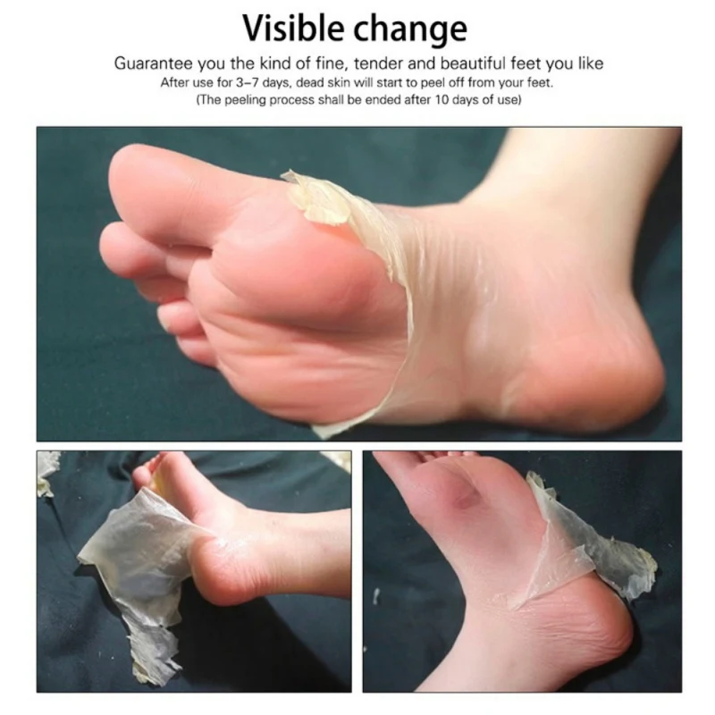 foot skin peeling foot skin peeling