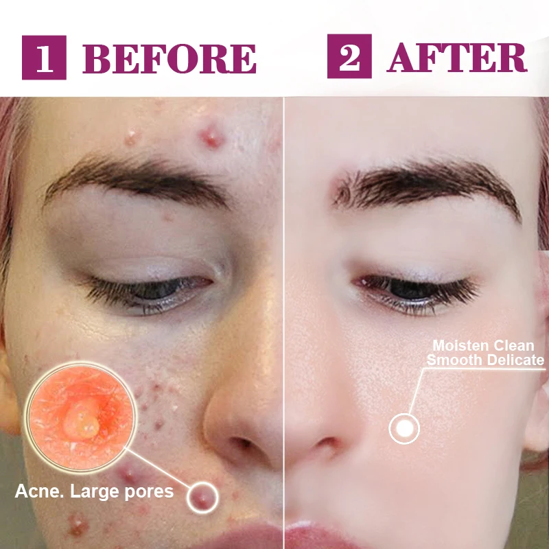 RtopR Propolis Repair Acne осветляющая сыворотка для удаления акне шрамовых пятен очищающая