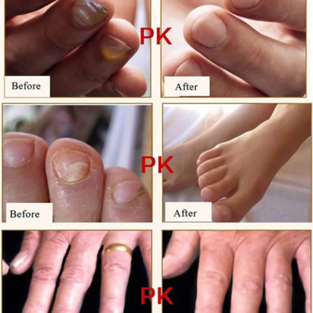 Антигрибковое Лечение ногтей ручка Onychomycosis Paronychia инфекция травяные пальцы ног ногти Здоровье ногтей грибок ногтей ремонт карандаш